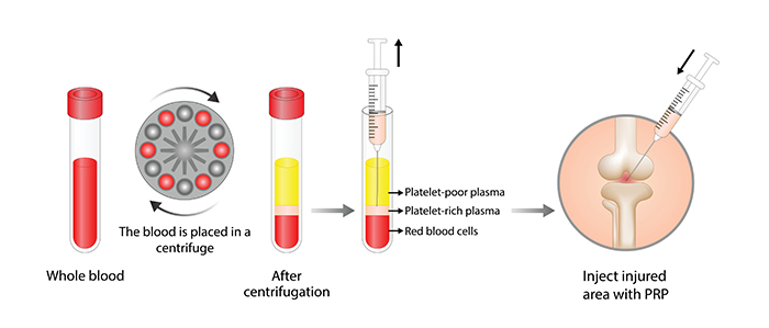 Platelet Rich Plasma PRP For Hip Injuries Philadelphia PA LALL Platelet Rich Plasma PRP For Hip Injuries Philadelphia PA LALL